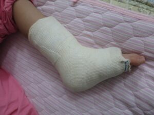 子どもの捻挫、様子見で大丈夫？骨折を見逃さないためのチェックポイント